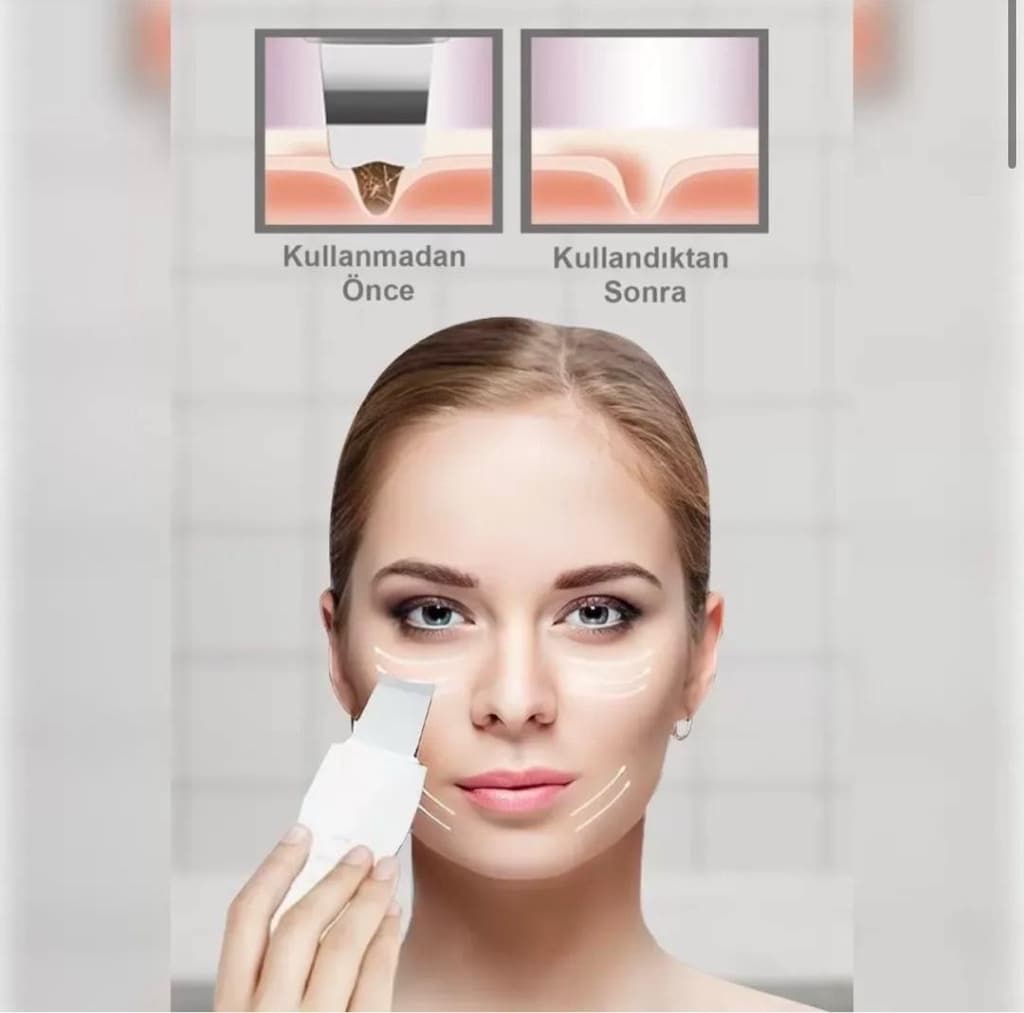 Ultrasonıc Siyah Nokta Akne Spatula Şarjlı Cilt Temizleyici - 2